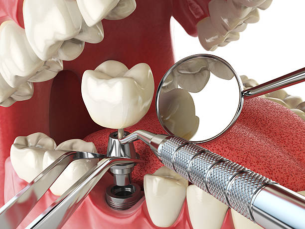 Best Emergency Root Canal Treatment in Remerton, GA